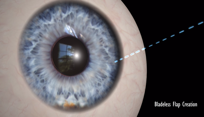 Femtosecond Laser from Behler Eye & Laser center