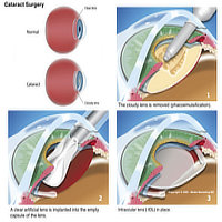 cataract-vision-center-dr-behler-eye