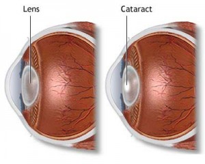 Cataract Surgery Treatment from Behler Eye & Laser Center