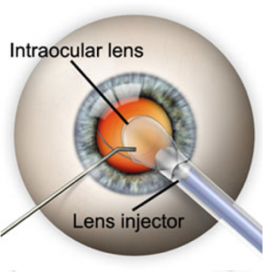 Cataract Surgery Procedure from Behler Eye & Laser Center